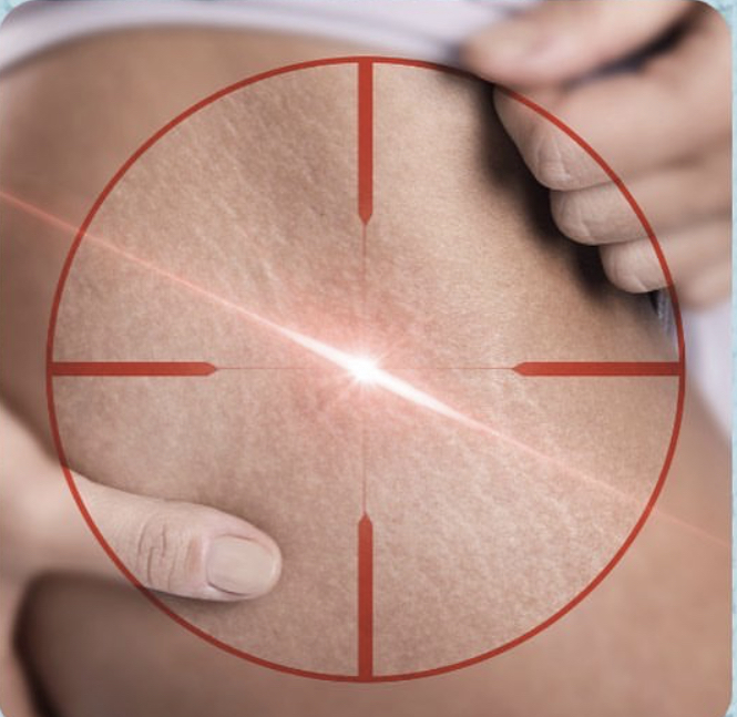 Resultados Tratamiento Estrías